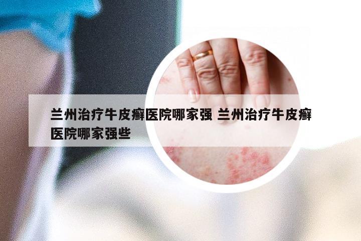 兰州治疗牛皮癣医院哪家强 兰州治疗牛皮癣医院哪家强些