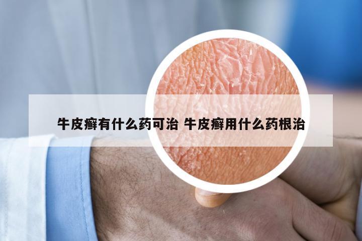 牛皮癣有什么药可治 牛皮癣用什么药根治