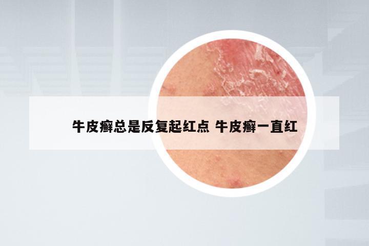牛皮癣总是反复起红点 牛皮癣一直红