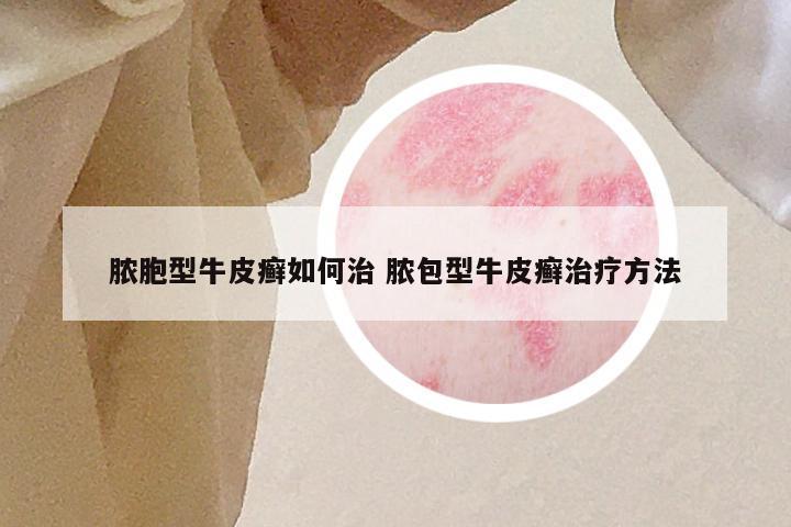 脓胞型牛皮癣如何治 脓包型牛皮癣治疗方法
