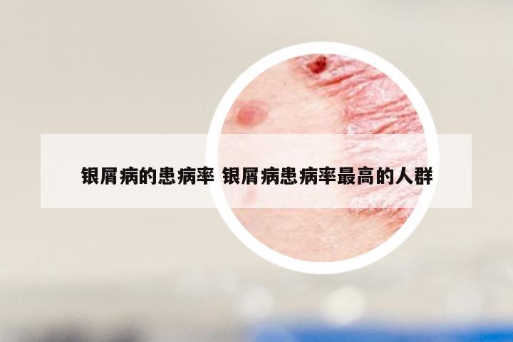 银屑病的患病率 银屑病患病率最高的人群