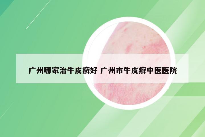 广州哪家治牛皮癣好 广州市牛皮癣中医医院