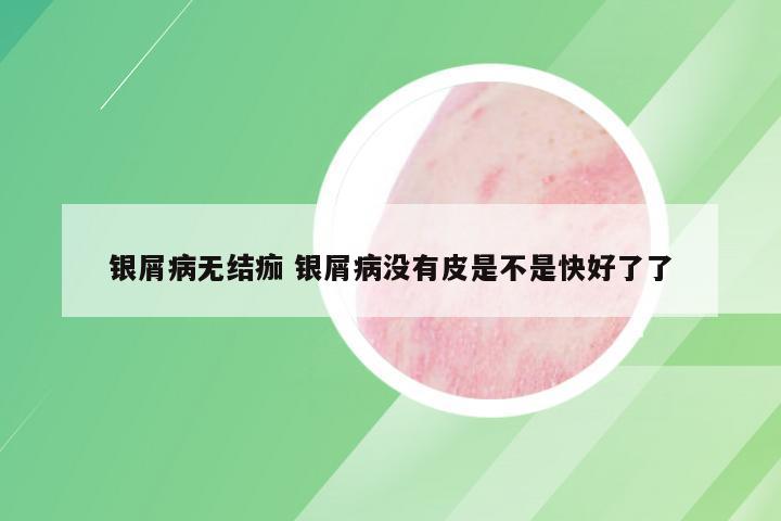 银屑病无结痂 银屑病没有皮是不是快好了了