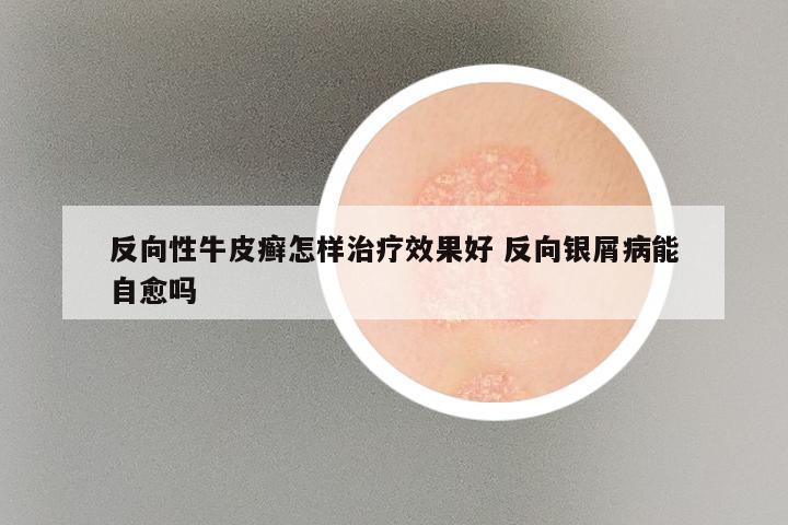 反向性牛皮癣怎样治疗效果好 反向银屑病能自愈吗