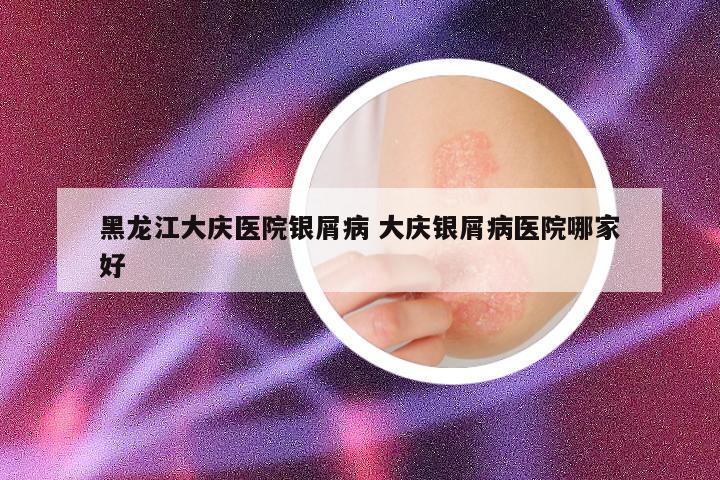 黑龙江大庆医院银屑病 大庆银屑病医院哪家好