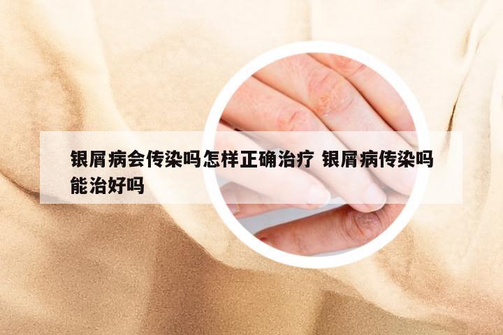 银屑病会传染吗怎样正确治疗 银屑病传染吗能治好吗