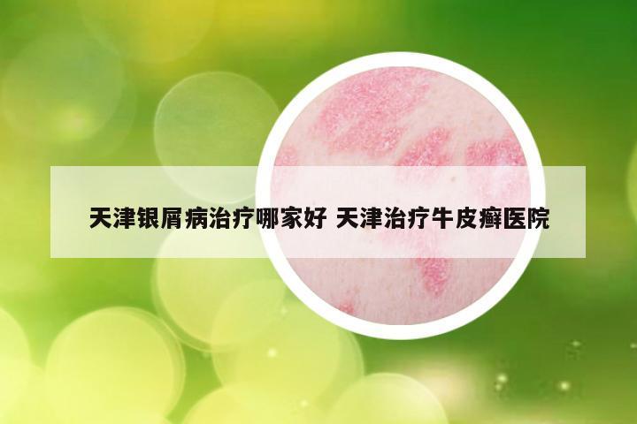 天津银屑病治疗哪家好 天津治疗牛皮癣医院