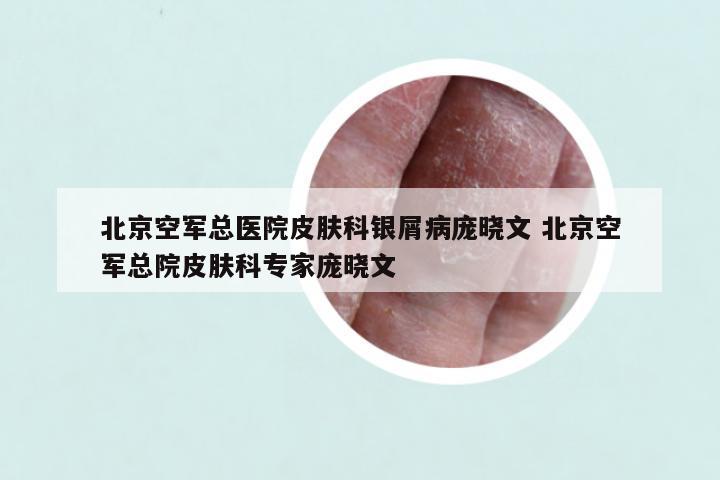 北京空军总医院皮肤科银屑病庞晓文 北京空军总院皮肤科专家庞晓文