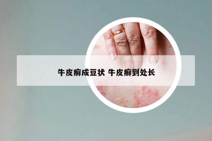 牛皮癣成豆状 牛皮癣到处长