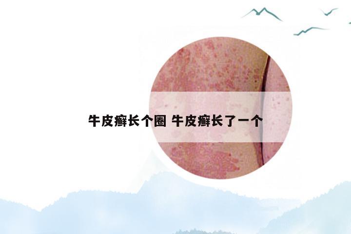 牛皮癣长个圈 牛皮癣长了一个
