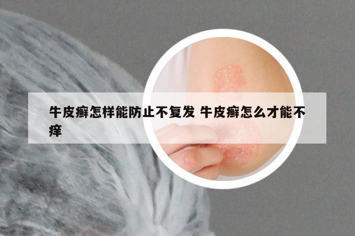 牛皮癣怎样能防止不复发 牛皮癣怎么才能不痒