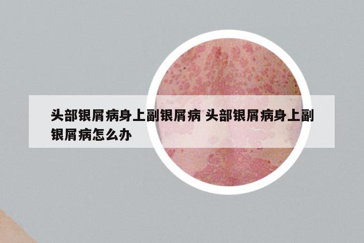 头部银屑病身上副银屑病 头部银屑病身上副银屑病怎么办