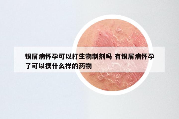 银屑病怀孕可以打生物制剂吗 有银屑病怀孕了可以摸什么样的药物