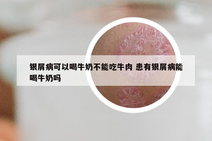 银屑病可以喝牛奶不能吃牛肉 患有银屑病能喝牛奶吗