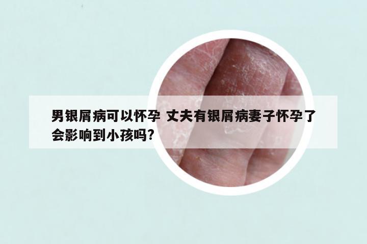 男银屑病可以怀孕 丈夫有银屑病妻子怀孕了会影响到小孩吗?