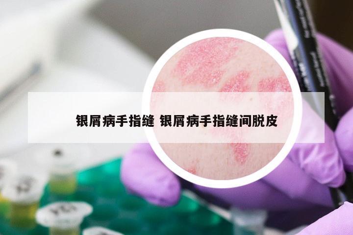 银屑病手指缝 银屑病手指缝间脱皮