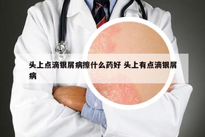 头上点滴银屑病擦什么药好 头上有点滴银屑病
