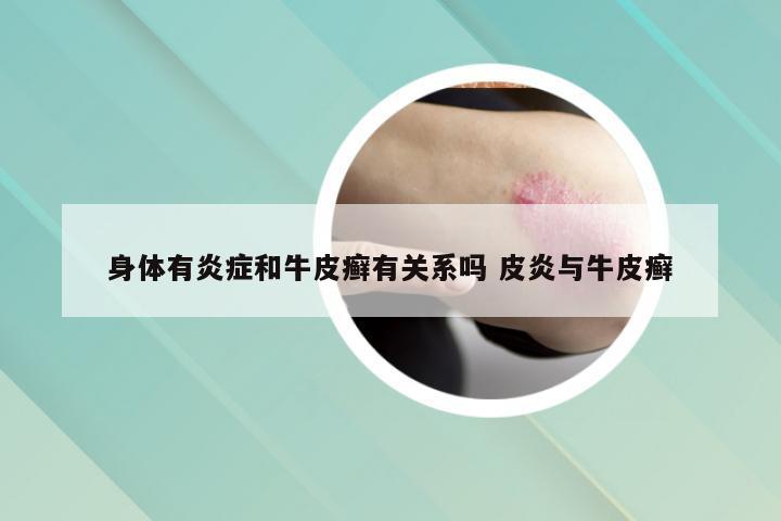 身体有炎症和牛皮癣有关系吗 皮炎与牛皮癣