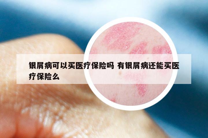 银屑病可以买医疗保险吗 有银屑病还能买医疗保险么