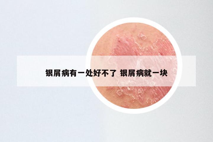 银屑病有一处好不了 银屑病就一块