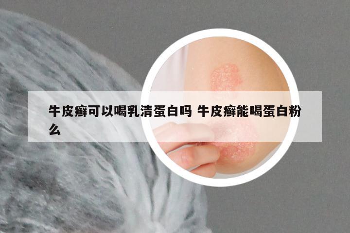 牛皮癣可以喝乳清蛋白吗 牛皮癣能喝蛋白粉么