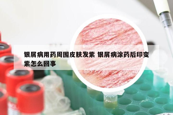 银屑病用药周围皮肤发紫 银屑病涂药后印变紫怎么回事