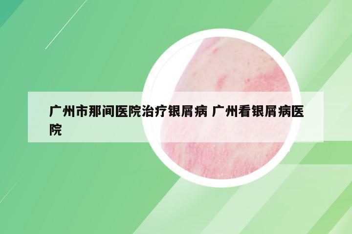 广州市那间医院治疗银屑病 广州看银屑病医院