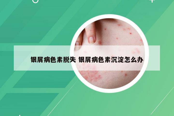 银屑病色素脱失 银屑病色素沉淀怎么办