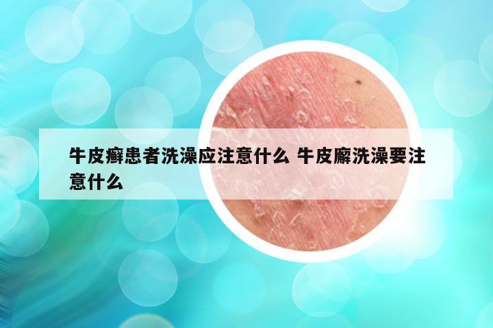牛皮癣患者洗澡应注意什么 牛皮廨洗澡要注意什么