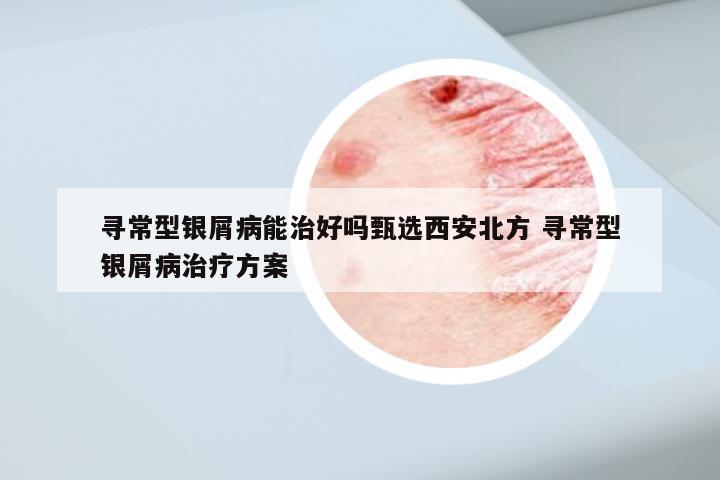 寻常型银屑病能治好吗甄选西安北方 寻常型银屑病治疗方案