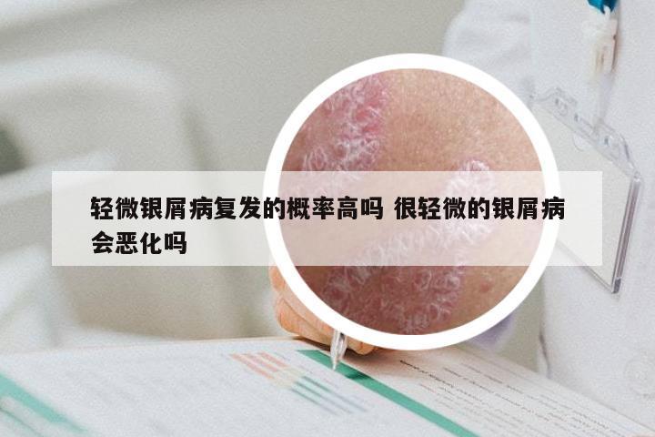 轻微银屑病复发的概率高吗 很轻微的银屑病会恶化吗