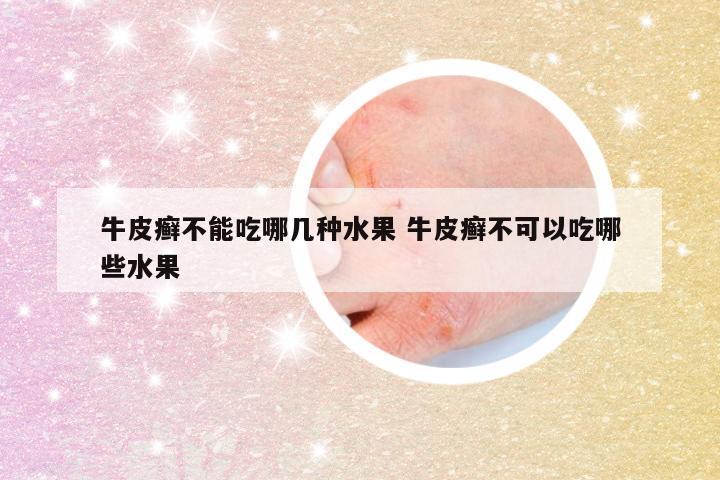 牛皮癣不能吃哪几种水果 牛皮癣不可以吃哪些水果