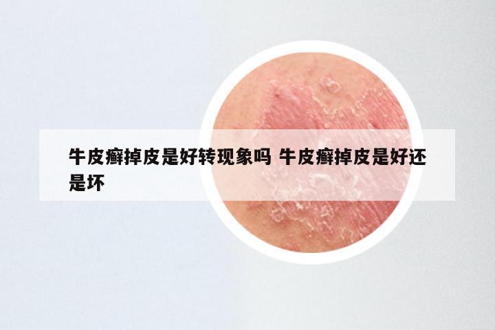 牛皮癣掉皮是好转现象吗 牛皮癣掉皮是好还是坏