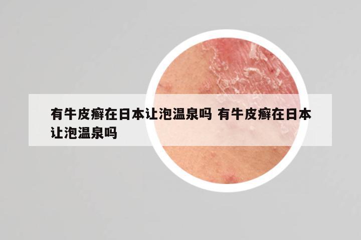 有牛皮癣在日本让泡温泉吗 有牛皮癣在日本让泡温泉吗