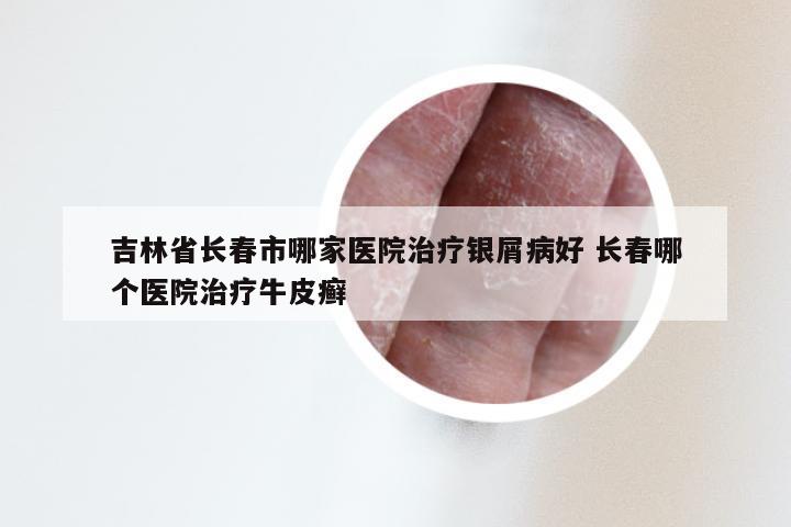 吉林省长春市哪家医院治疗银屑病好 长春哪个医院治疗牛皮癣