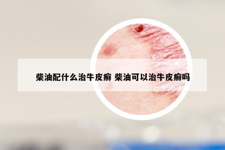 柴油配什么治牛皮癣 柴油可以治牛皮癣吗