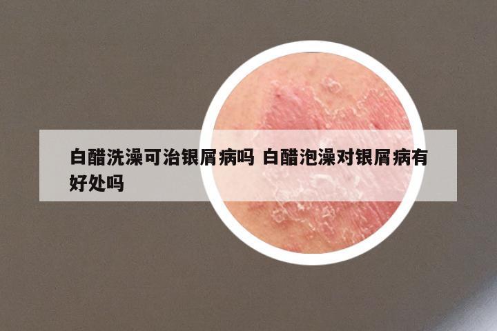 白醋洗澡可治银屑病吗 白醋泡澡对银屑病有好处吗