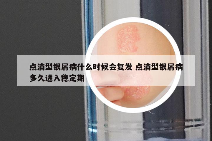 点滴型银屑病什么时候会复发 点滴型银屑病多久进入稳定期