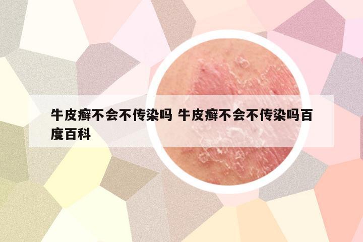 牛皮癣不会不传染吗 牛皮癣不会不传染吗百度百科