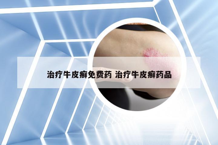 治疗牛皮癣免费药 治疗牛皮癣药品