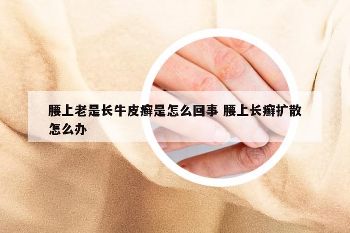 腰上老是长牛皮癣是怎么回事 腰上长癣扩散怎么办