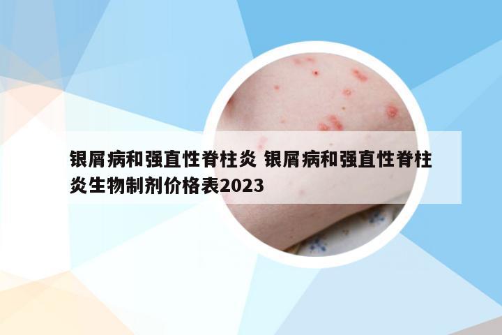 银屑病和强直性脊柱炎 银屑病和强直性脊柱炎生物制剂价格表2023