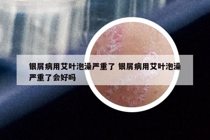 银屑病用艾叶泡澡严重了 银屑病用艾叶泡澡严重了会好吗