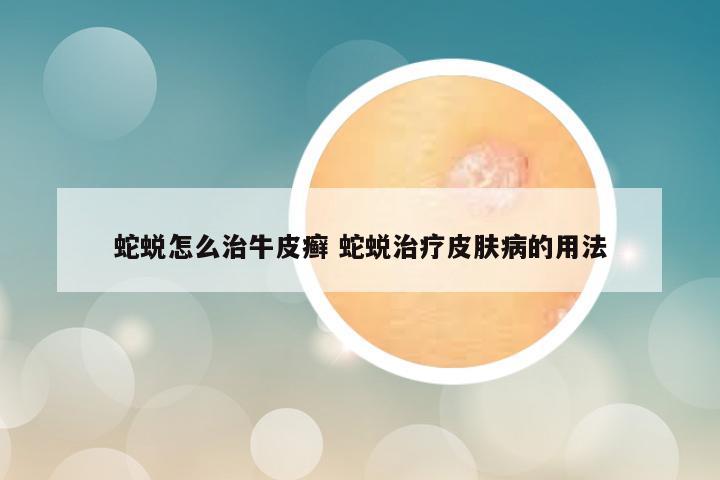 蛇蜕怎么治牛皮癣 蛇蜕治疗皮肤病的用法