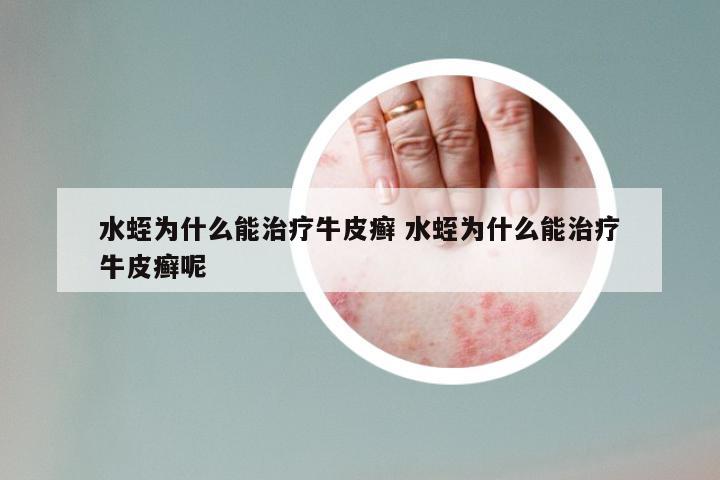 水蛭为什么能治疗牛皮癣 水蛭为什么能治疗牛皮癣呢