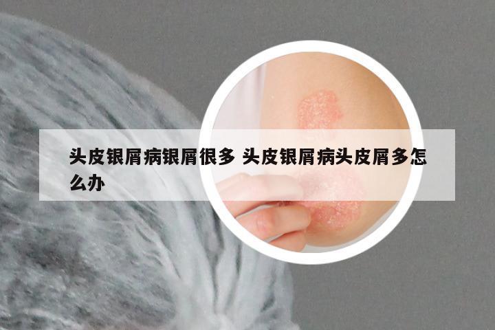 头皮银屑病银屑很多 头皮银屑病头皮屑多怎么办