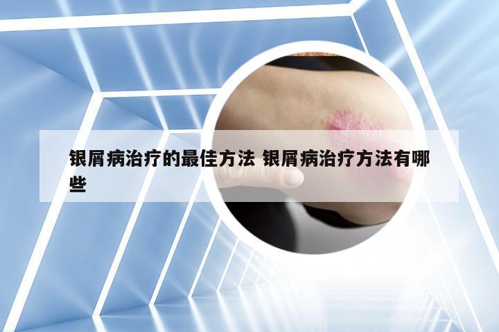 银屑病治疗的最佳方法 银屑病治疗方法有哪些