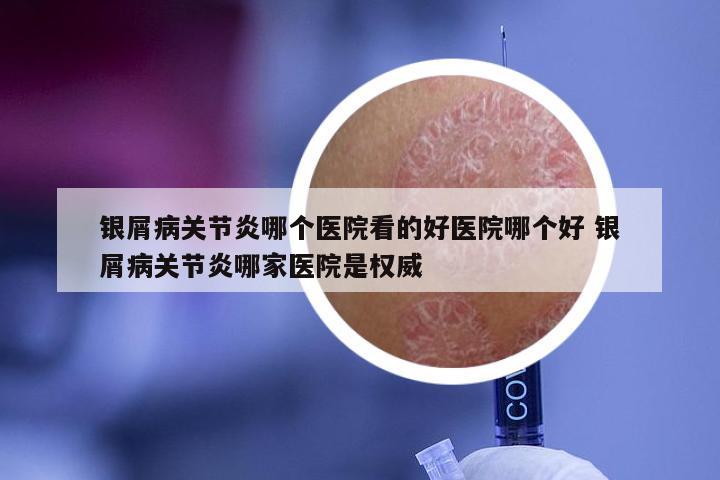 银屑病关节炎哪个医院看的好医院哪个好 银屑病关节炎哪家医院是权威