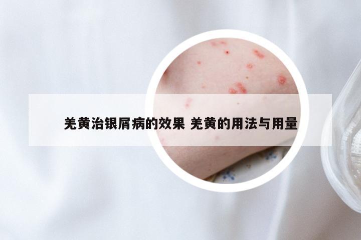 羌黄治银屑病的效果 羌黄的用法与用量