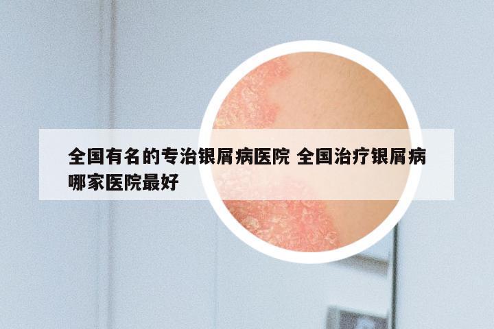 全国有名的专治银屑病医院 全国治疗银屑病哪家医院最好